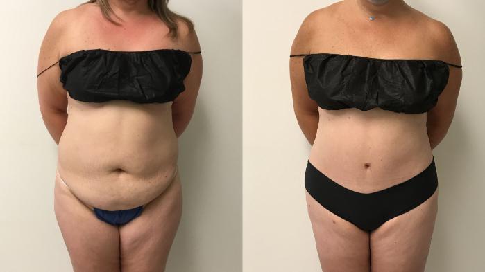 Before & After Tummy Tuck 360 Case 271 Front View in Barrington, Illinois