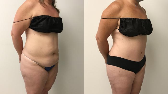 Before & After Tummy Tuck 360 Case 271 Right Oblique View in Barrington, Illinois