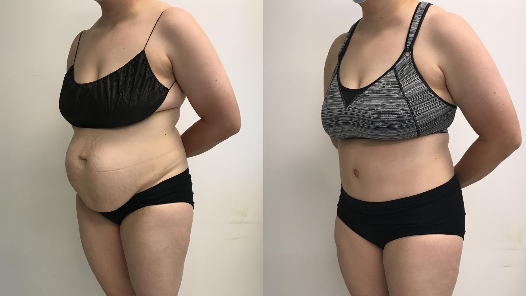 Before & After Tummy Tuck 360 Case 281 Left Oblique View in Barrington, Illinois