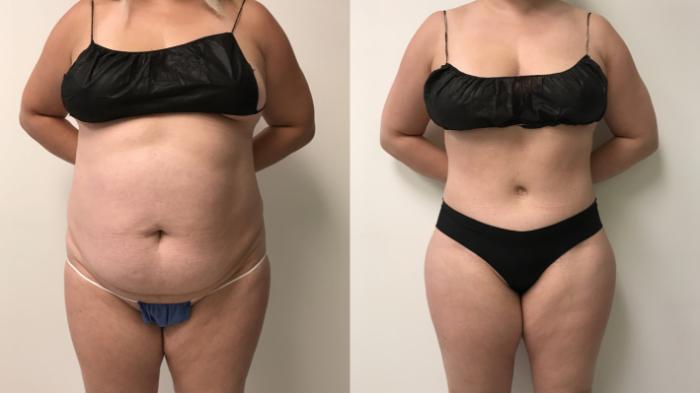 Before & After Tummy Tuck 360 Case 282 Front View in Barrington, Illinois
