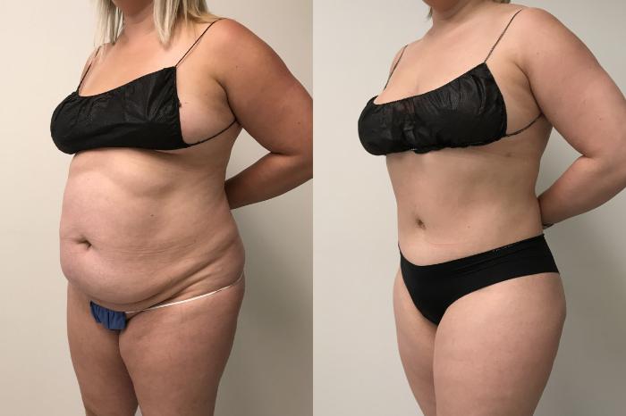Before & After Tummy Tuck 360 Case 282 Left Oblique View in Barrington, Illinois
