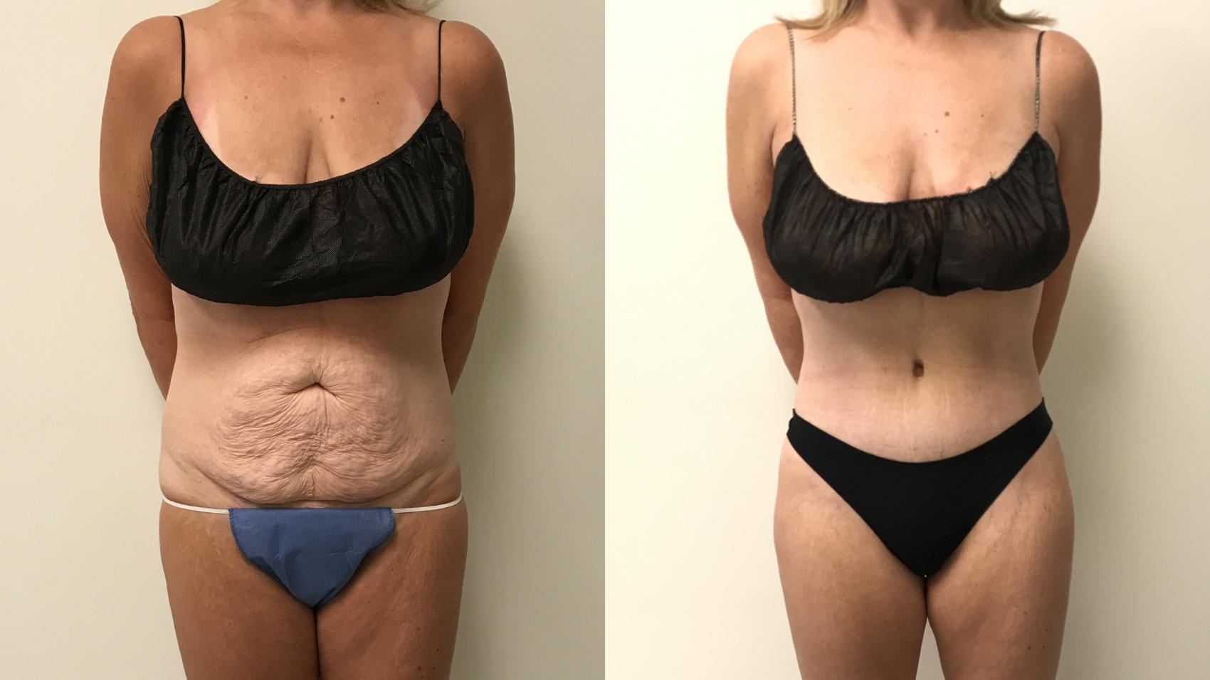 Before & After Tummy Tuck 360 Case 291 Front View in Barrington, Illinois
