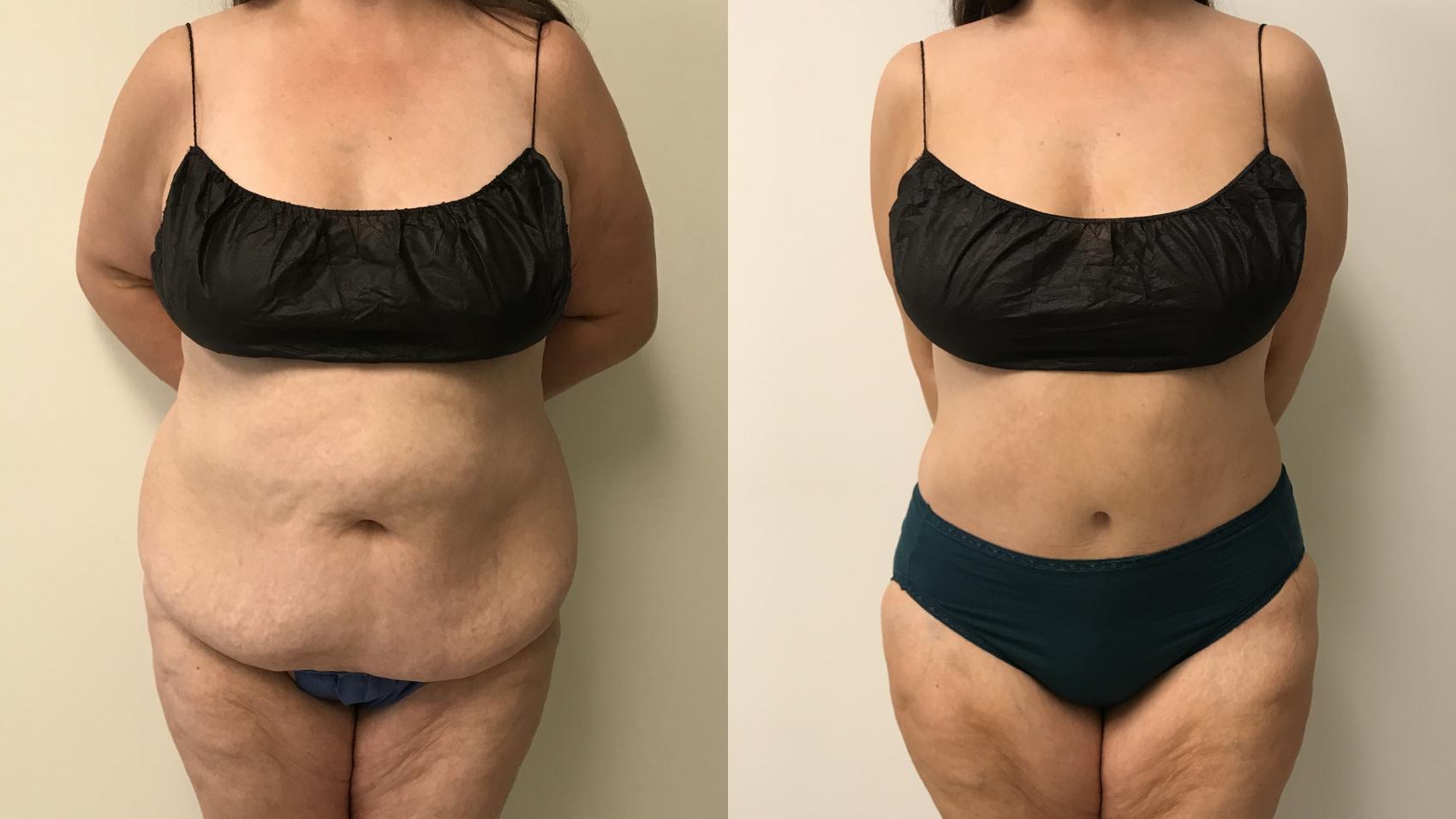 Before & After Tummy Tuck 360 Case 302 Front View in Barrington, Illinois