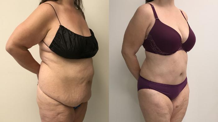 Before & After Tummy Tuck 360 Case 302 Right Oblique View in Barrington, Illinois