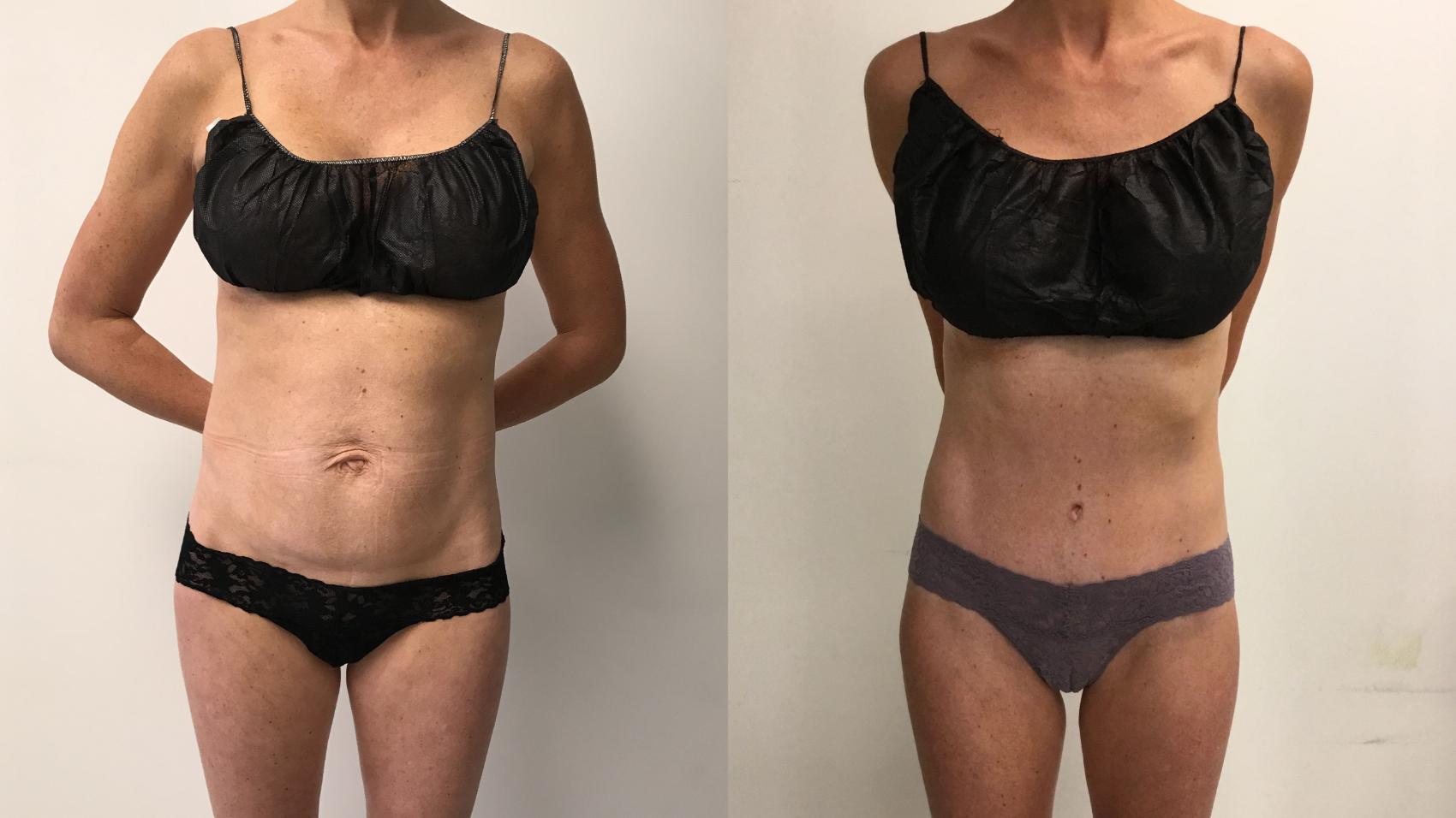 Before & After Tummy Tuck 360 Case 303 Front View in Barrington, Illinois