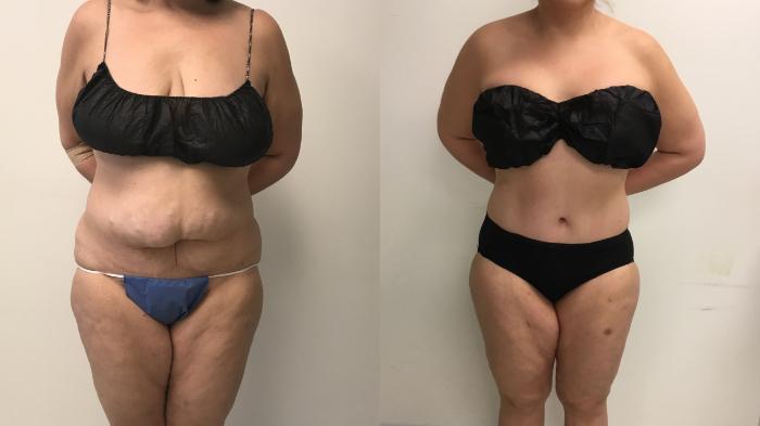 Before & After Tummy Tuck 360 Case 324 Front View in Barrington, Illinois
