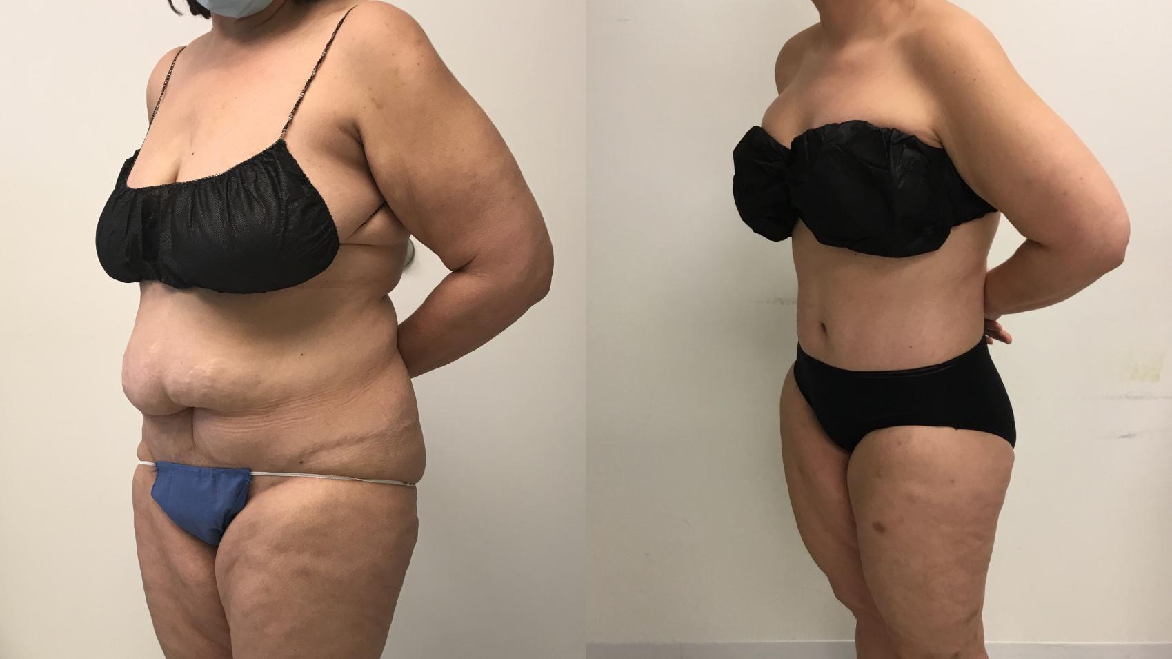 Before & After Tummy Tuck 360 Case 324 Left Oblique View in Barrington, Illinois