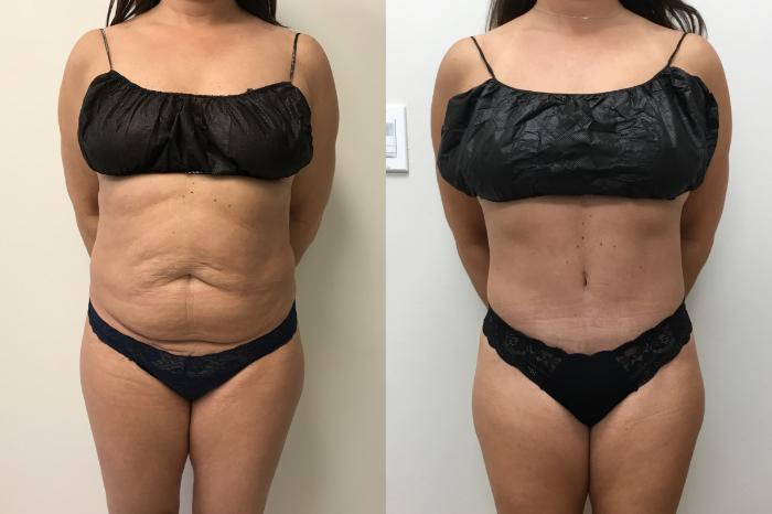 Before & After Tummy Tuck 360 Case 331 Front View in Barrington, Illinois