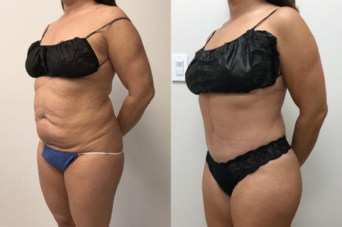 Before & After Tummy Tuck 360 Case 331 Left Oblique View in Barrington, Illinois