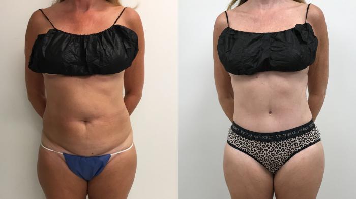 Before & After Tummy Tuck 360 Case 334 Front View in Barrington, Illinois