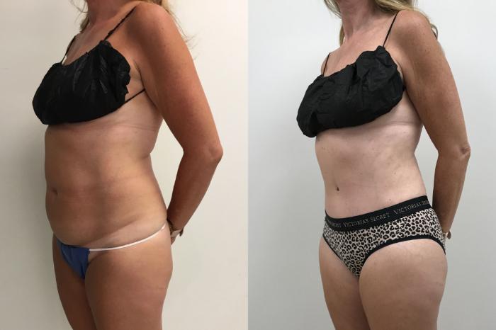 Before & After Tummy Tuck 360 Case 334 Left Oblique View in Barrington, Illinois