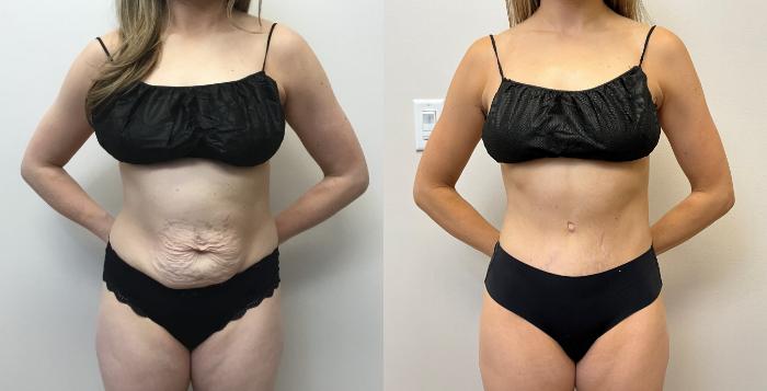 Before & After Tummy Tuck 360 Case 355 Front View in Barrington, Illinois