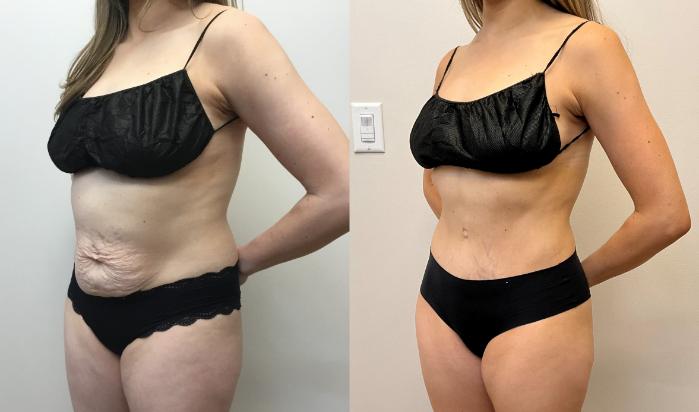 Before & After Tummy Tuck 360 Case 355 Left Oblique View in Barrington, Illinois