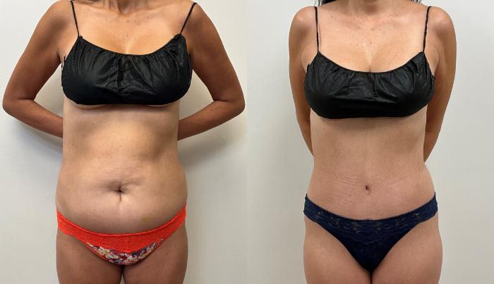 Before & After Tummy Tuck 360 Case 388 Front View in Barrington, Illinois