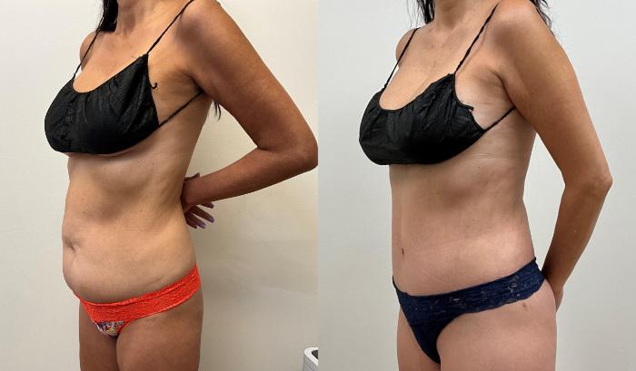 Before & After Tummy Tuck 360 Case 388 Left Oblique View in Barrington, Illinois