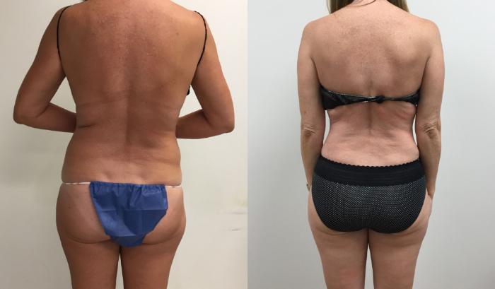 Before & After Tummy Tuck 360 Case 409 Back View in Barrington, Illinois