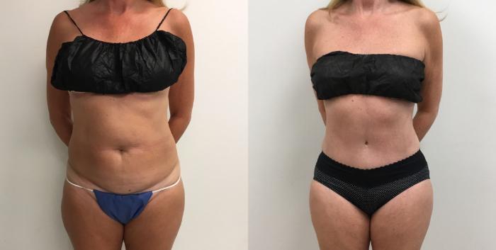 Before & After Tummy Tuck 360 Case 409 Front View in Barrington, Illinois