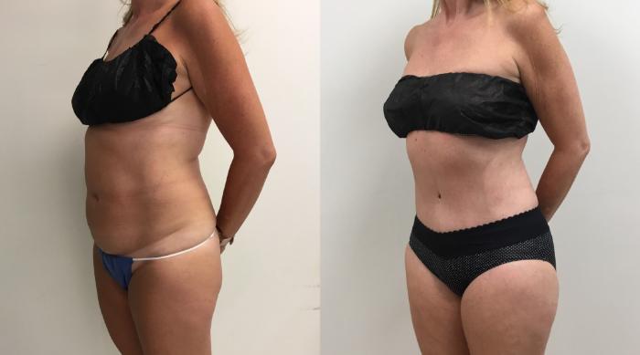 Before & After Tummy Tuck 360 Case 409 Left Oblique View in Barrington, Illinois