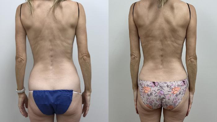 Before & After Tummy Tuck 360 Case 419 Back View in Barrington, Illinois