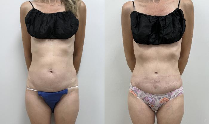 Before & After Tummy Tuck 360 Case 419 Front View in Barrington, Illinois