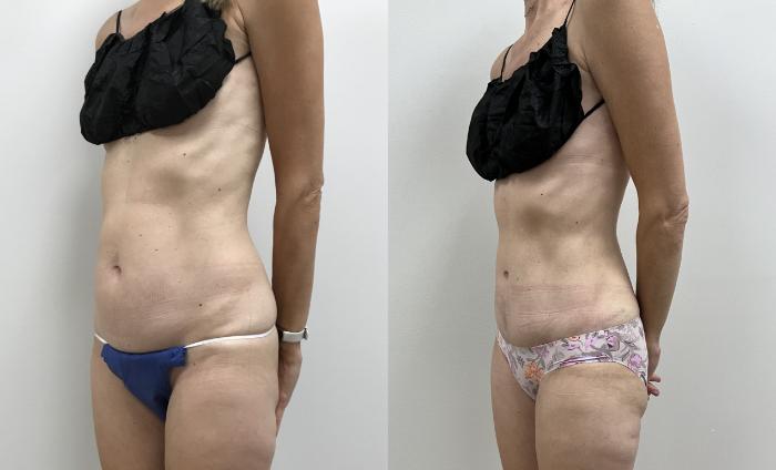 Before & After Tummy Tuck 360 Case 419 Left Oblique View in Barrington, Illinois