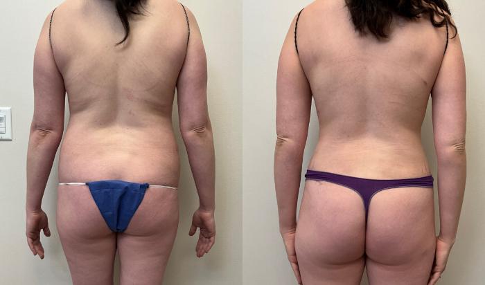 Before & After Tummy Tuck 360 Case 429 Back View in Barrington, Illinois
