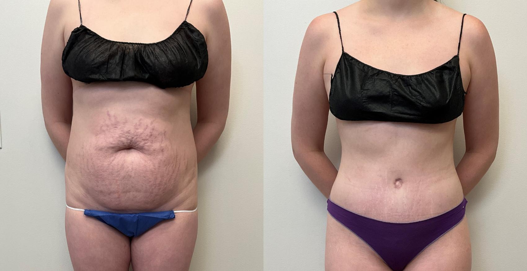Before & After Tummy Tuck 360 Case 429 Front View in Barrington, Illinois