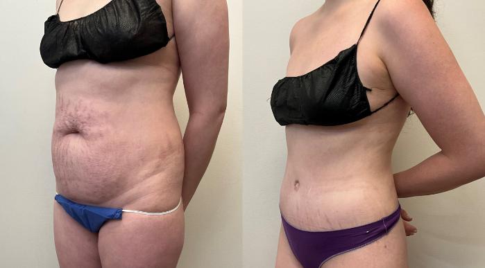 Before & After Tummy Tuck 360 Case 429 Right Oblique View in Barrington, Illinois