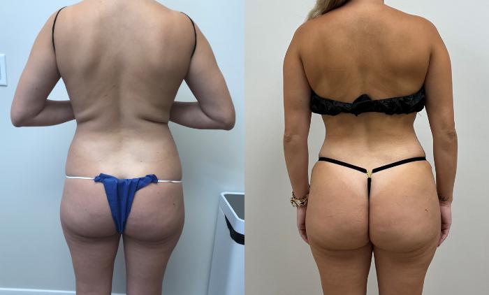 Before & After Tummy Tuck 360 Case 431 Back View in Barrington, Illinois