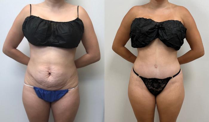 Before & After Tummy Tuck 360 Case 431 Front View in Barrington, Illinois