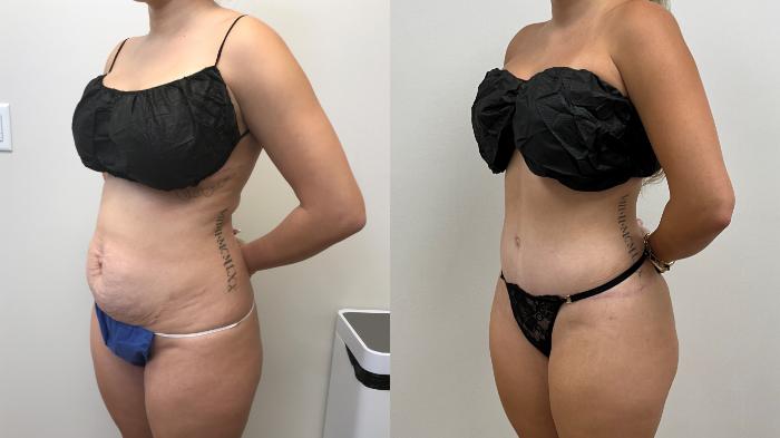 Before & After Tummy Tuck 360 Case 431 Left Oblique View in Barrington, Illinois