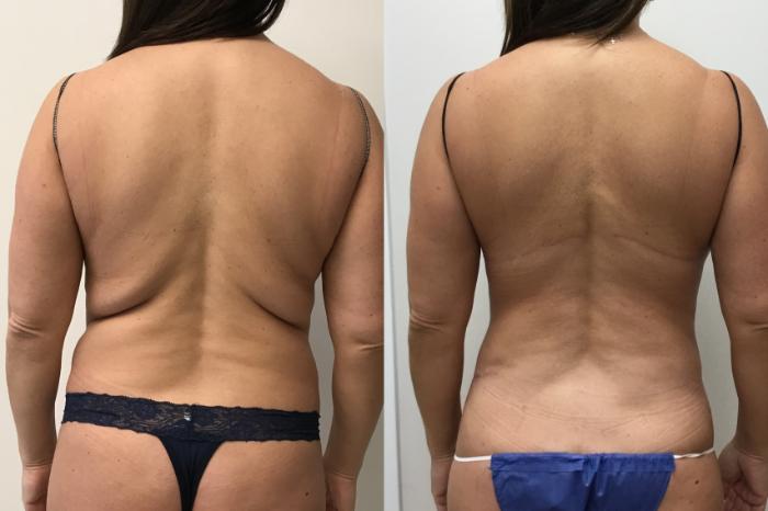 Upper Back Lift Before & After Gallery