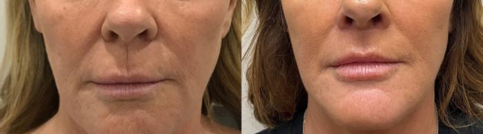 Before & After Upper Lip Lift Case 425 Front View in Barrington, Illinois