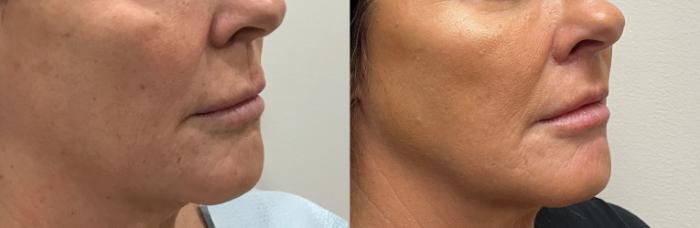 Before & After Upper Lip Lift Case 425 Right Oblique View in Barrington, Illinois